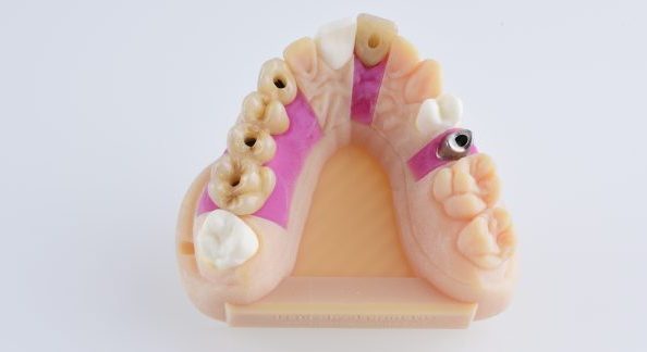 moldes odontológicos em 3D
