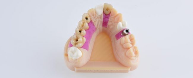 moldes odontológicos em 3D